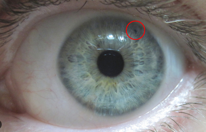 Iridotomia Iridotomia